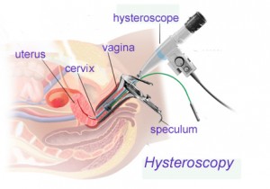 Hysteroscopy