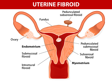 Uterine Fibroid